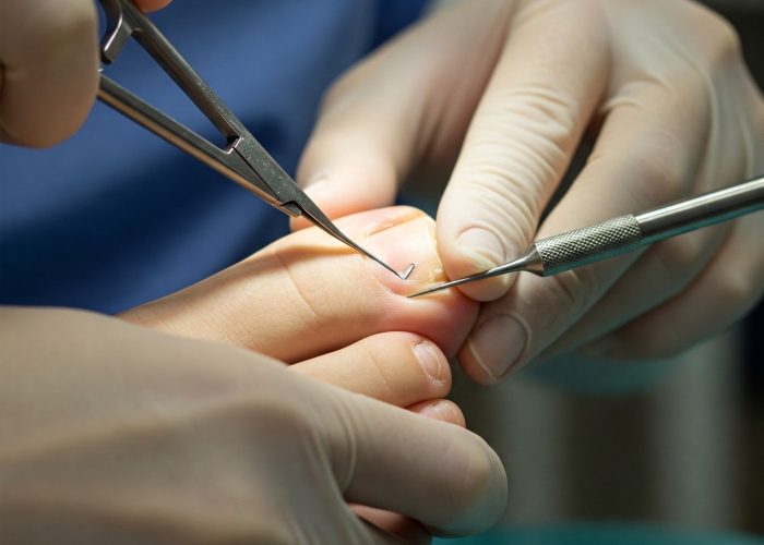 Cantengan bikin nyeri dan bengkak.