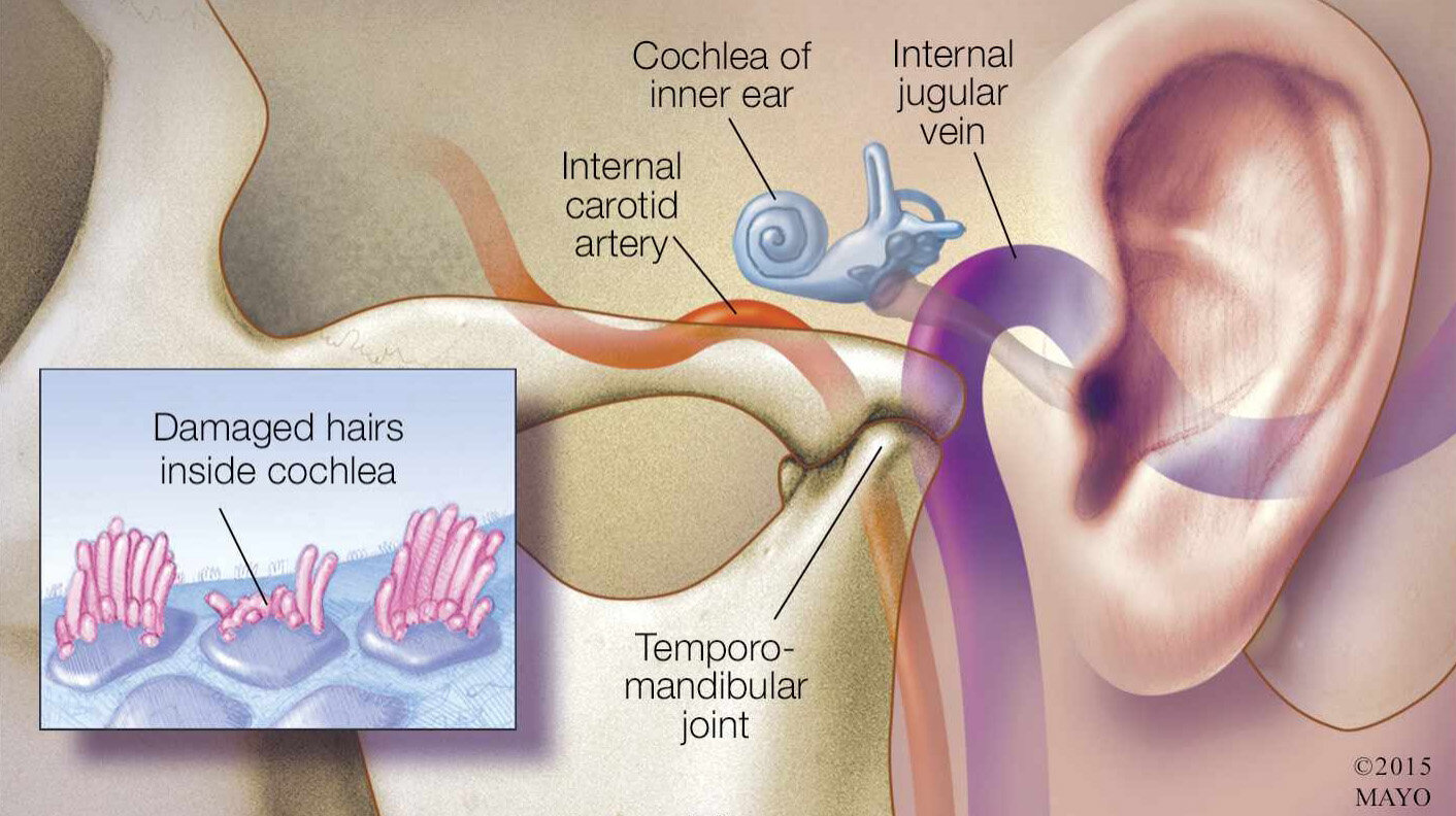 Tinnitus.