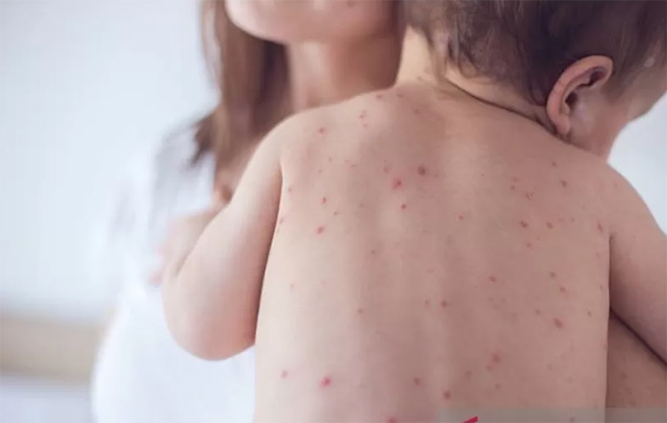 Ilustrasi campak pada bayi.