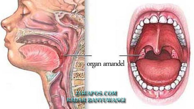 sakit-saat-menelan-mungkin-amandel