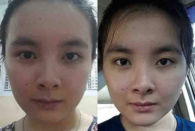 jalani-terapi-setrika-wajah-wajah-langsung-tirus