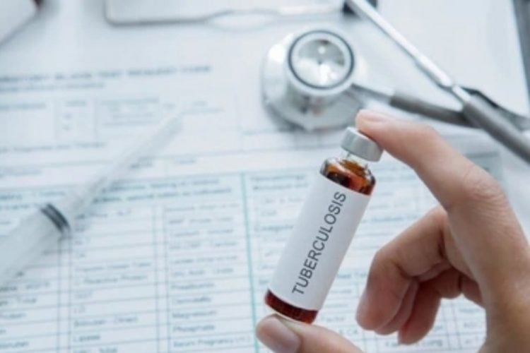 Ilustrasi tuberculosis (TBC). TBC adalah penyakit menular yang disebabkan kuman Mycobacterium tuberculosis yang secara umum dapat diklasifikasikan ke dalam dua kategori, yaitu TBC Sensitif Obat (TBC SO) dan TBC Resisten Obat (TBC RO). (Shutterstock) 